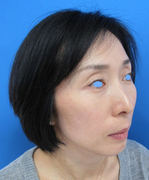 目の下のたるみ、目のくまでお悩みの方、切らずに完璧に解決します。TCB-R法　手術直後　症例写真